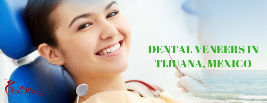 Dental Veneers in Tijuana, Mexico Dental Veneers in Tijuana, Mexico